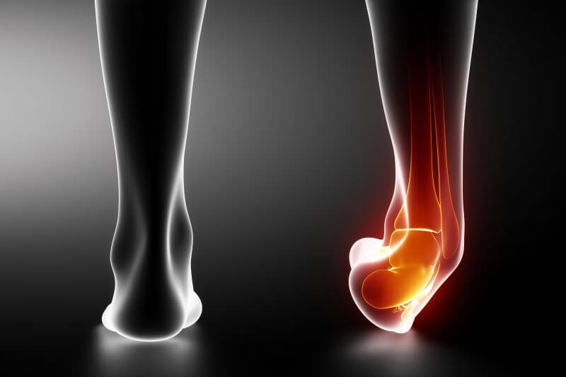 volleyball ankle injuries, sprains and strains
