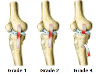 grades of mcl ligament injury