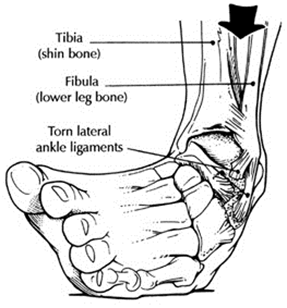 most common ankle injuries