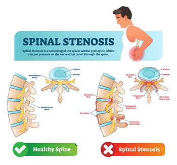 most common symptoms of spinal stenosis