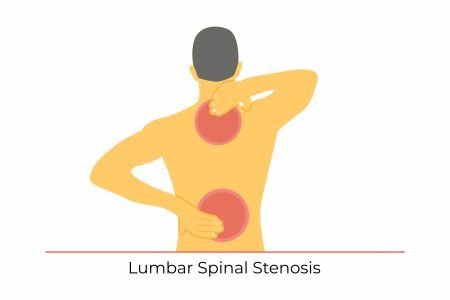 importance of using back brace for spinal stenosis treatment