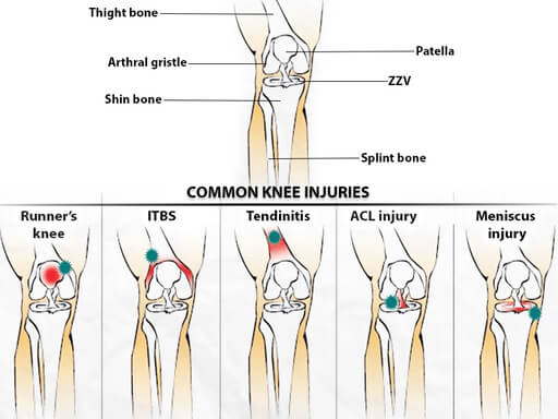 most common knee injuries in volleyball