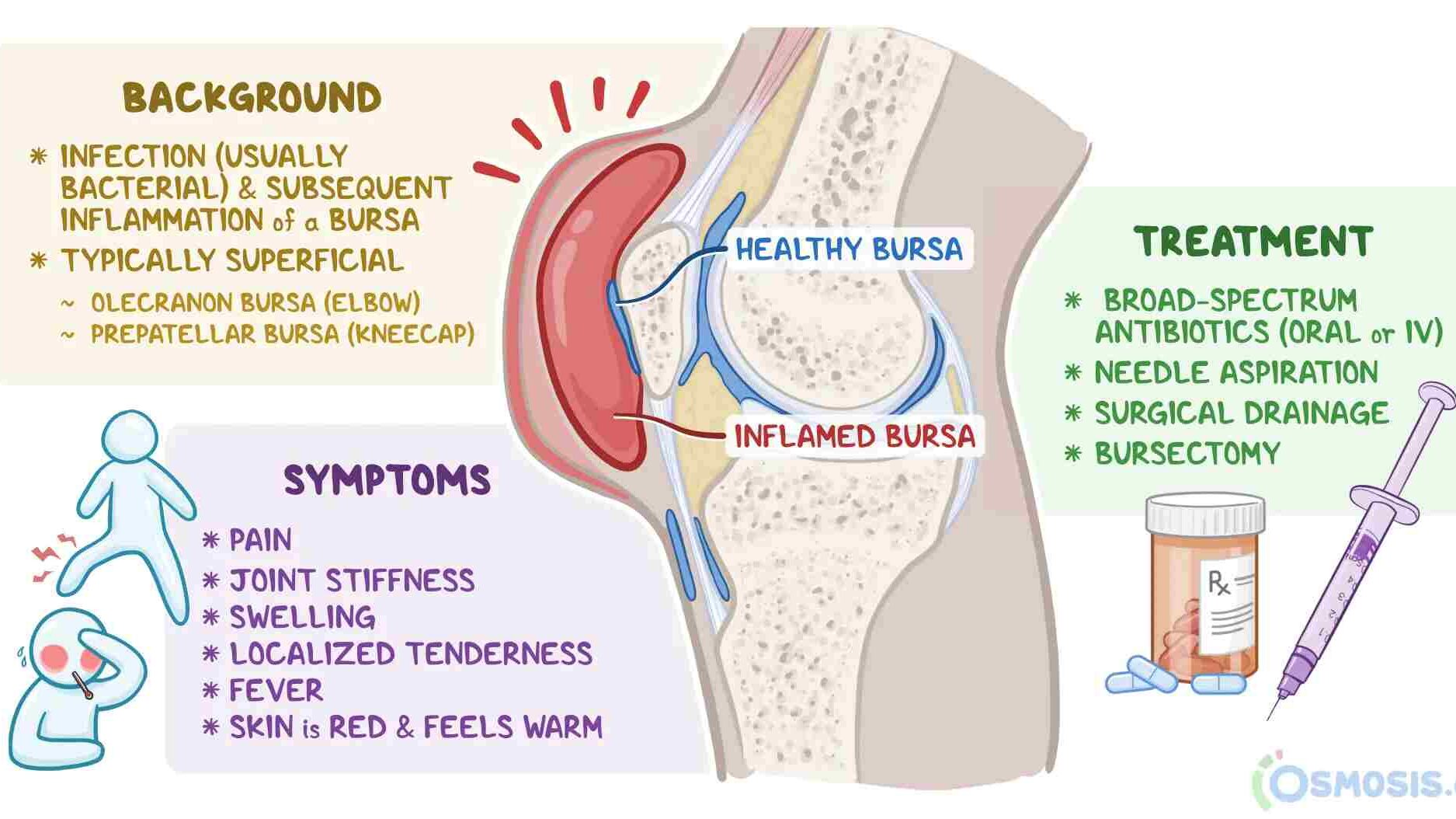 elbow bursitis summary