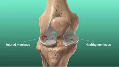 meniscus injury explain